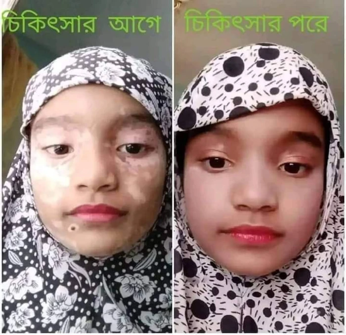 Sumifun Vitiligo Cream